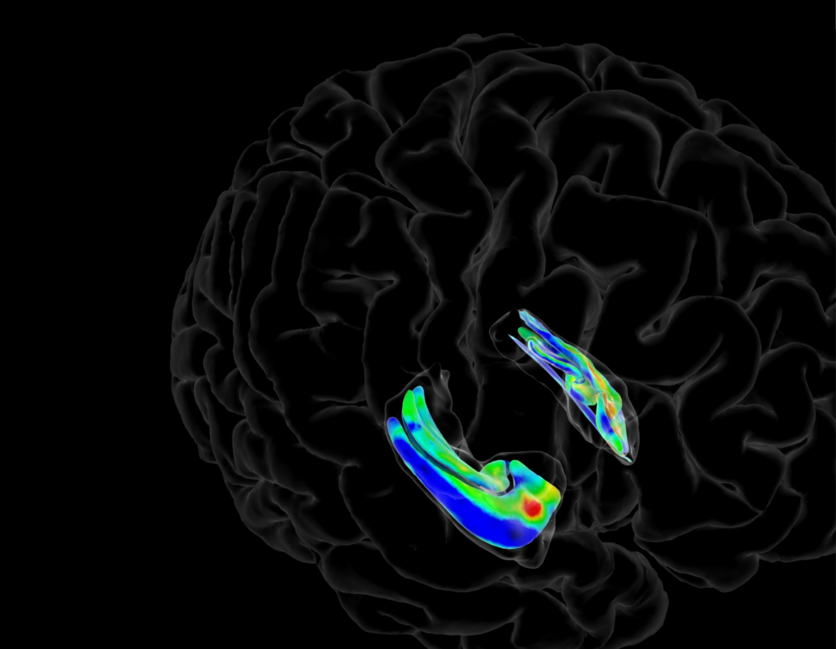 new Alzheimers_hippocampus_color_map_data_from_Kirsten_V3_0120 jpg