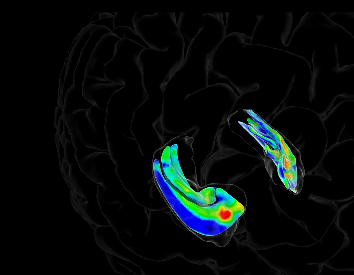 2Alzheimers_hippocampus_color_map_data_from_Kirsten_V3_0300 jpg 