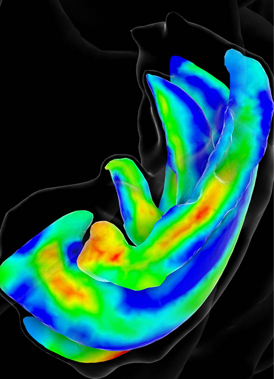 Alzheimers_hippocampus_color_map_data_from_Kirsten_V3_0870 jpg