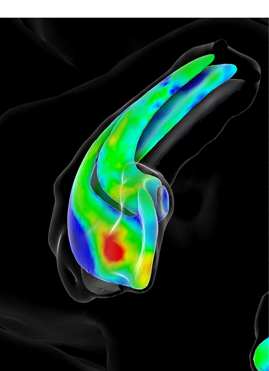 Alzheimers_hippocampus_color_map_data_from_Kirsten_V3_0870 jpg